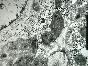 F,17y. | megamitochondria - Wilson disease F,17y. | megamitochondria - Wilson disease